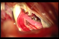 blood vessel compressing the trigeminal nerve 